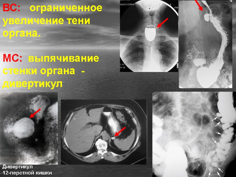 ВС:   ограниченное увеличение тени органа.  МС:  выпячивание  стенки органа